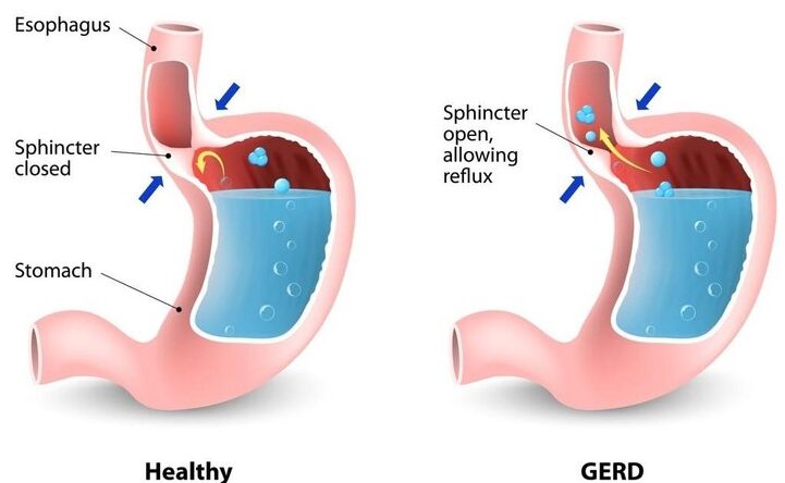 "Gastroenterology treatment options for IBS and GERD, including medication, diet, and lifestyle changes for effective relief."