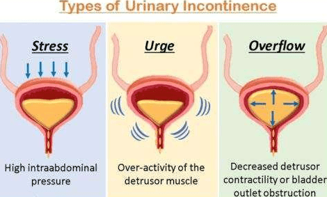 Urinary Incontinence -Tolterodine
