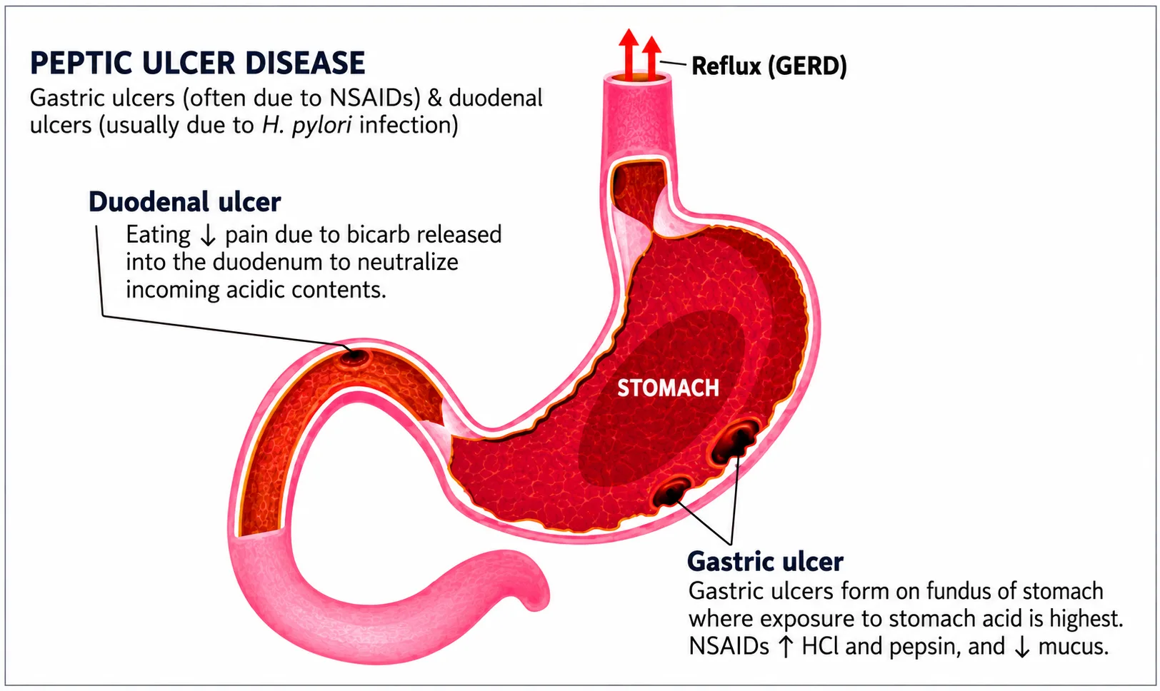 High-resolution medical illustration showing peptic ulcer disease with gastric ulcer, duodenal ulcer, and GERD reflux in the stomach and duodenum anatomy.